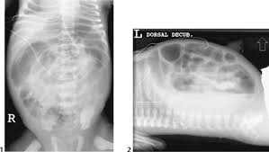 61 Hirschsprung S Disease Radiology Key