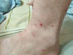 Image result for Trombicula autumnalis bites