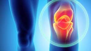 Arthrose Erkennen Und Behandeln Symptome Hausmittel