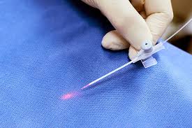 laser haarentfernung wesel online