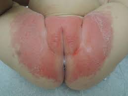 Image result for diaper dermatitis