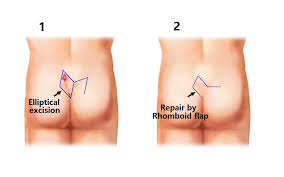 These are cavities with a Pilonidal Sinus Colorectal Surgeons Sydney