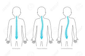 The vertebral column, also known as the backbone or spine, is part of the axial skeleton.the vertebral column is the defining characteristic of a vertebrate in which the notochord (a flexible rod of uniform composition) found in all chordates has been replaced by a segmented series of bone: Boy Scoliosis Flat Vector Illustration Types Of Scoliosis Of Royalty Free Cliparts Vectors And Stock Illustration Image 143591261