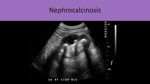 Cyst Formation In The Kidneys Diagnostic Medical Sonography Ultrasound Sonography Education Humor