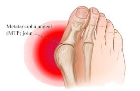 Pin On Plantar Fasciitis