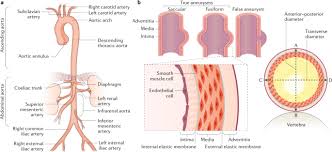 An aneurysm can occur anywhere in the vascular tree. Abdominal Aortic Aneurysms Nature Reviews Disease Primers