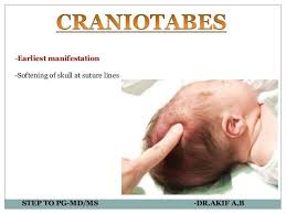 Image result for Craniotabes