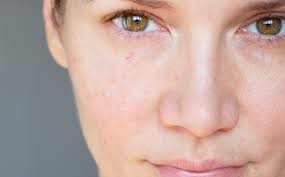 This step is critical regardless of your skin concerns, but doubly important when you're dealing. Facial Redness How To Reduce