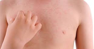 Simptomele infecției cu stafilococ auriu în cazul copiilor sunt: Probleme Ale Pielii La Copil Probleme Cu Pielea La Copil