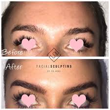 The pdo thread introduction technology is based on using the natural skin tension lines, which also causes an effect similar to a surgical facelift. The Brow Lift Facial Sculpting