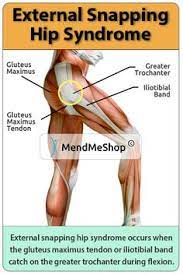 Snapping Hip Syndrome