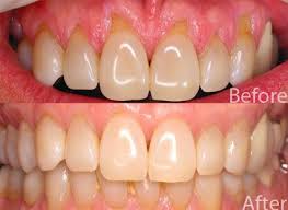 Can you vape after dental implant surgery? Gum Surgery Before And After Photos Dental News Network