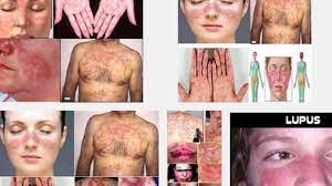 Herpes adalah penyakit kulit yang penyebab utamanya adalah virus, biasanya akan muncul gelembung yang berisi air dan secara berkelompok. Dokter Apakah Penyakit Lupus Menular Tribun Jateng