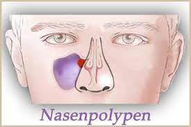 Nasenpolypen Bei Babys Und Kleinkindern Gegenverstopftenase De