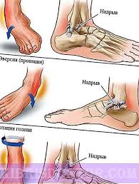 Anda juga boleh menggunakan pelapik lembut. Ligamen Pada Pergelangan Kaki Gejala Rawatan Pemulihan Ulasan Penyakit Dan Keadaan 2021