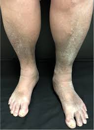 Image result for Edema
