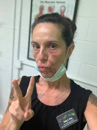 I have lupus and all mask breaking out my face! I am forced to wear while  working! What to do? Having autoimmune disorder already I have issues. I  work part time to