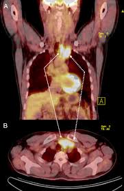 Can be superimposed on multinodular goiter or follicular cancer. A 44 Year Old Man With A History Of Thyroid Cancer Underwent Fdg Pet Ct Download Scientific Diagram