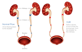 Separate pelves and ureters) • contrast seen only in the lower pole because that is the only ureter that has reflux. Vesicoureteral Kidney Reflux Information