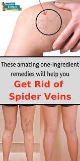 These Amazing One Ingredient Remedies Will Help You Get Rid Of Spider Veins Get Rid Of Spider Veins Spider Vein Remedies Spider Veins