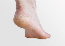Dry Cracked Heels Prevent Manage Florida Foot Ankle