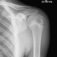 Image result for Humerus Growth Plates