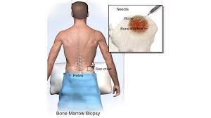 Photo essay at nice university hospital, archet hospital about bone marrow donation, france. Bone Marrow Aspiration Biopsy