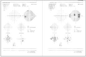 Image result for Visual Field Deficit