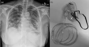 Risk Of Nosocomial Transmission Of Coronavirus Disease 2019 An Experience In A General Ward Setting In Hong Kong Journal Of Hospital Infection