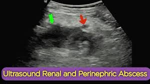 Image result for Perinephric Abscess