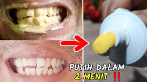 Penanganan karang gigi hanya dapat dilakukan oleh dokter gigi. Search Youtube Channels Noxinfluencer