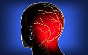 Pin On Headaches