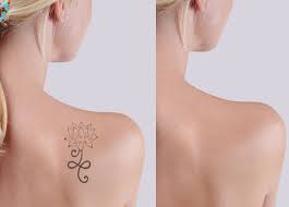 Looking for a laser tattoo removal in the queens, new york city? Tattoo Removal In New York Home Facebook