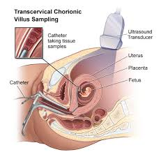 Maybe you would like to learn more about one of these? Chorionic Villus Sampling Cvs Johns Hopkins Medicine