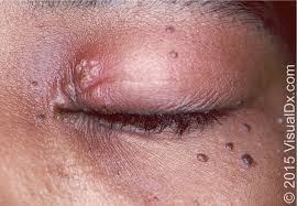 Suspect mosquito bites if there are bites on other parts of the body. Differential Diagnosis Of The Swollen Red Eyelid American Family Physician