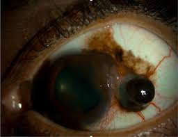 Sell eyelash enhancer liquid chinese botanical ingredient. Conjunctival Melanoma Current Treatments And Future Options Springerlink