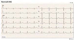Høyre grenblokk har ikke så store konsekvenser, og kan til og med være en medfødt normalvariant. Pq Tiden
