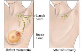 Image result for Mastectomy