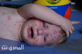شكل حبوب الجدري عند الاطفال يكون على هيئة بثور. Ifwyrjdmftzx4m