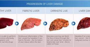 Some common cancer signs that should result in a visit to the emergency room or to a doctor as soon as possible include: 10 Early Signs Of Liver Problems You Should Never Ignore Positivemed Liver Cancer Liver Failure Healthy Liver
