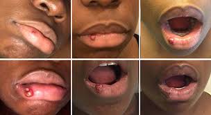 Tanning beds use can also increase the risk for lip cancer. When A Bump On The Lip Becomes A Rapidly Growing Tumor Mount Sinai New York