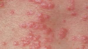 Semua orang dewasa mendapat kebaikan dari rawatan antiviral di awal penyakit terutama yang kurang kerosakan otak akibat radangan otak. Kudis Buta Punca Simptom Dan Rawatan Root Of Science