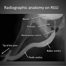 Image result for Retrograde Urethrogram