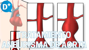 Occasionally, there may be abdominal, back, or leg pain. Causas Y Tratamiento De Las Aneurismas De Aorta Youtube