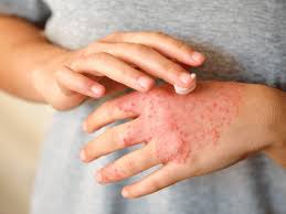 Image result for Atopic eczema atopic dermatitis