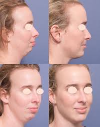 What Is Genioplasty Chin Surgery Before And After Photos Plastic Surgery Chin Augmentation Botox Injections
