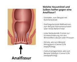 Welche Hausmittel Und Salben Helfen Gegen Eine Analfissur