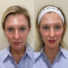 For my girlies who like to go harddd with their treatments. 😂 Giggle allll  you want but this is a common misconception when it comes...