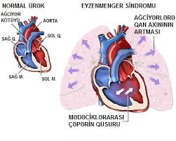 The tetralogy of fallot is a congenital heart defect which classically has four anatomical components. Eisenmenger S Syndrome Wikipedia