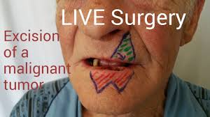What is the most common cause of oral and pharyngeal cancer in the united states? Lamboul Abbe Live Surgery Reconstructia De Buza Dupa Excizia Tumorilor Youtube
